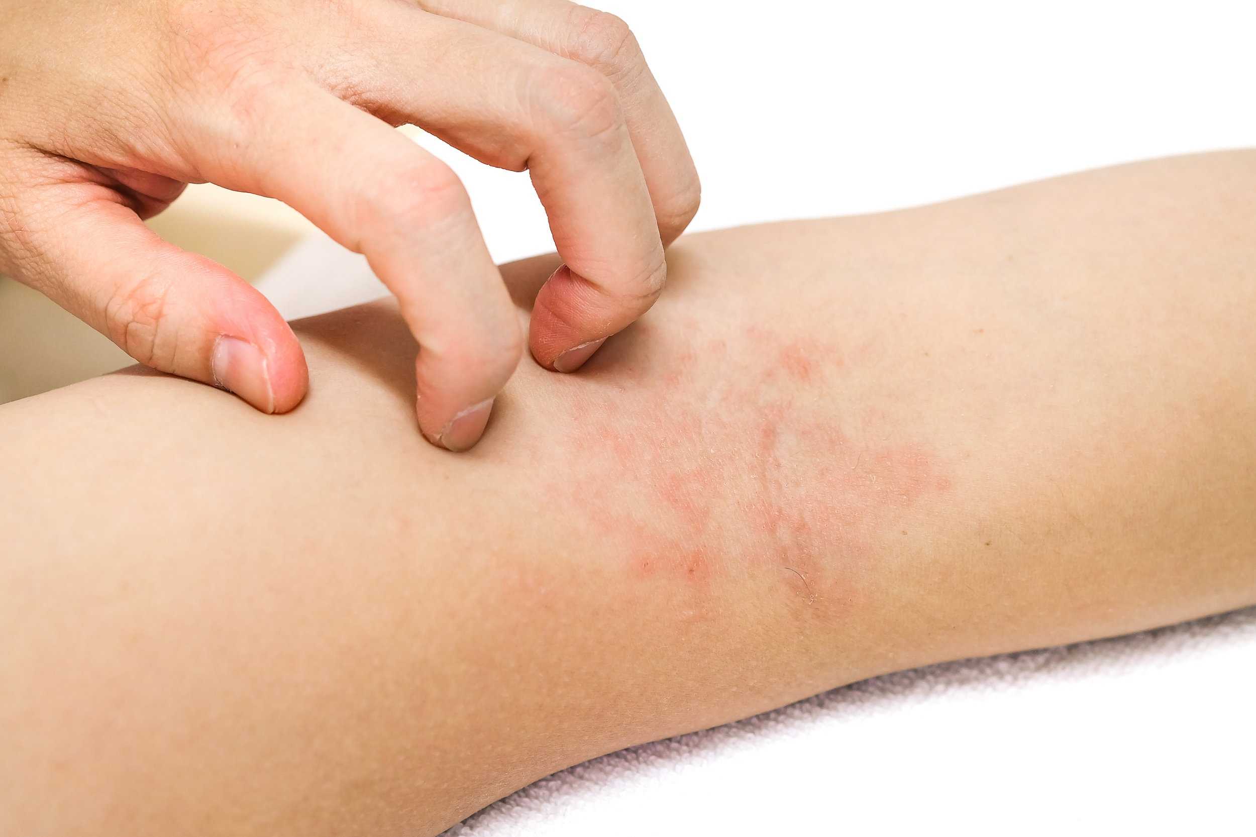 10 eczema facts - Health Service Navigator