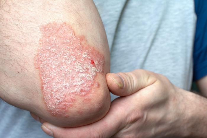 10 psoriasis facts - Health Service Navigator