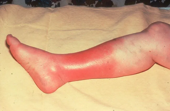 10 cellulitis facts - Health Service Navigator