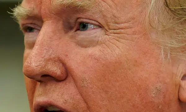 Bermad vride Korrespondent Donald Trump's rosacea - orange make up or fake nose? - Health Service  Navigator